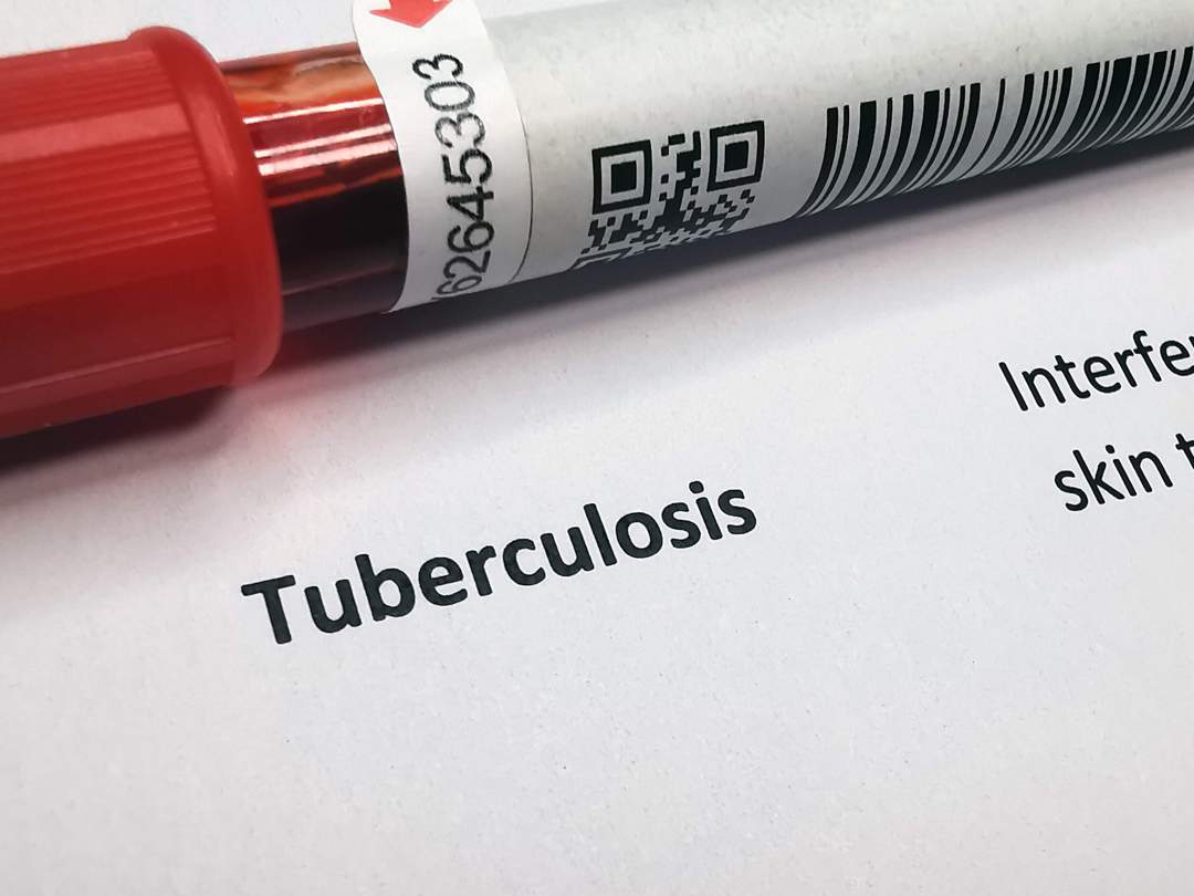 News24 | Undiagnosed TB poses challenge for South Africa, Mozambique