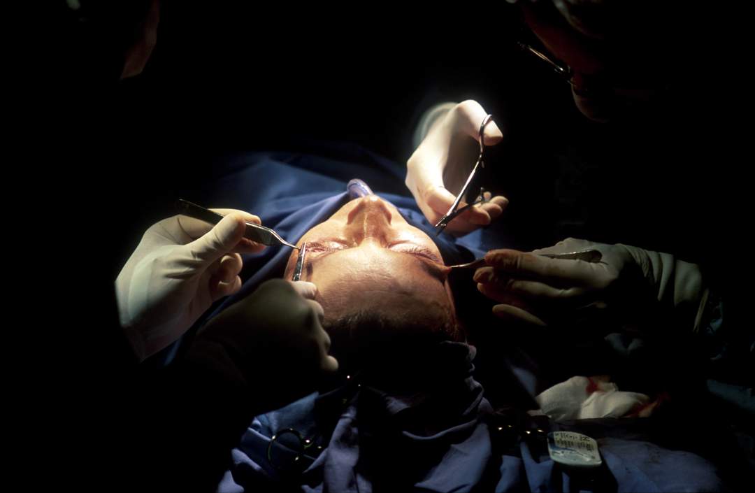 The Risks of TikTok’s Viral Fox-Eye Surgery Trend