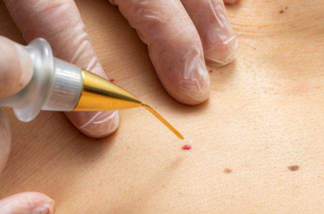 YOUR HEALTH | I’ve spotted red moles on my skin – should I be worried?